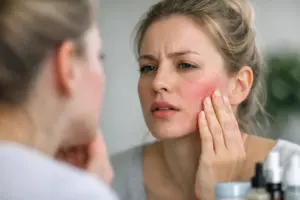 What Causes Reactive Skin Flareups?